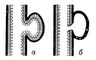 Аневризма: а — истинная; б — ложная.