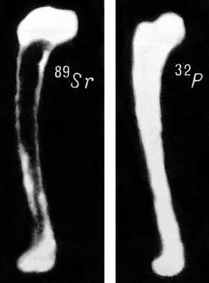 Отложение радиоизотопов в костях